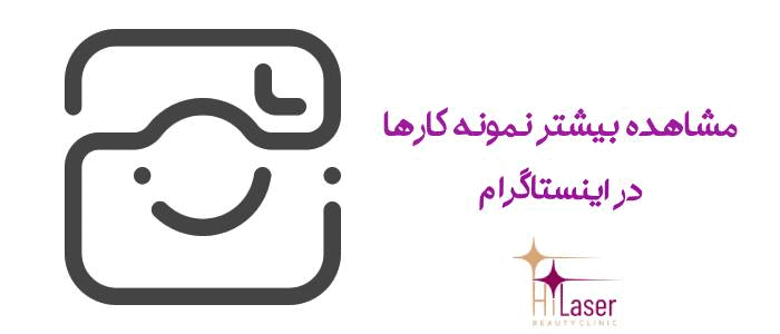 لیزر موهای زائد صورت