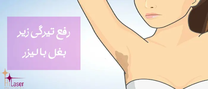 رفع تیرگی زیر بغل با لیزر