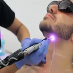 لیزر مو های زائد مردان