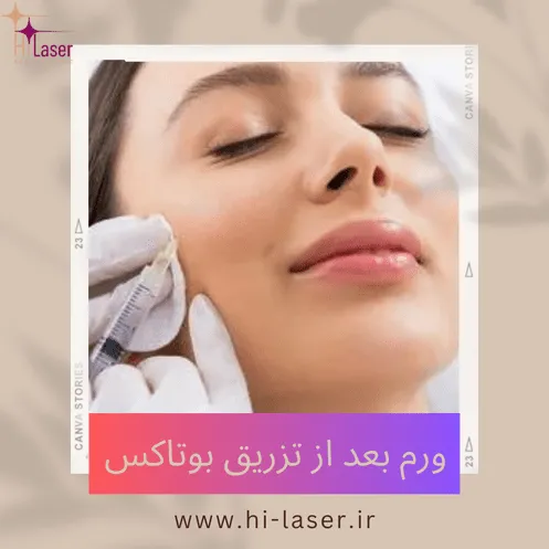 ورم بعد از تزریق بوتاکس