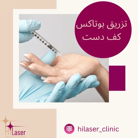 تزریق بوتاکس کف دست