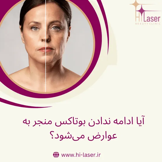 ادامه ندادن بوتاکس