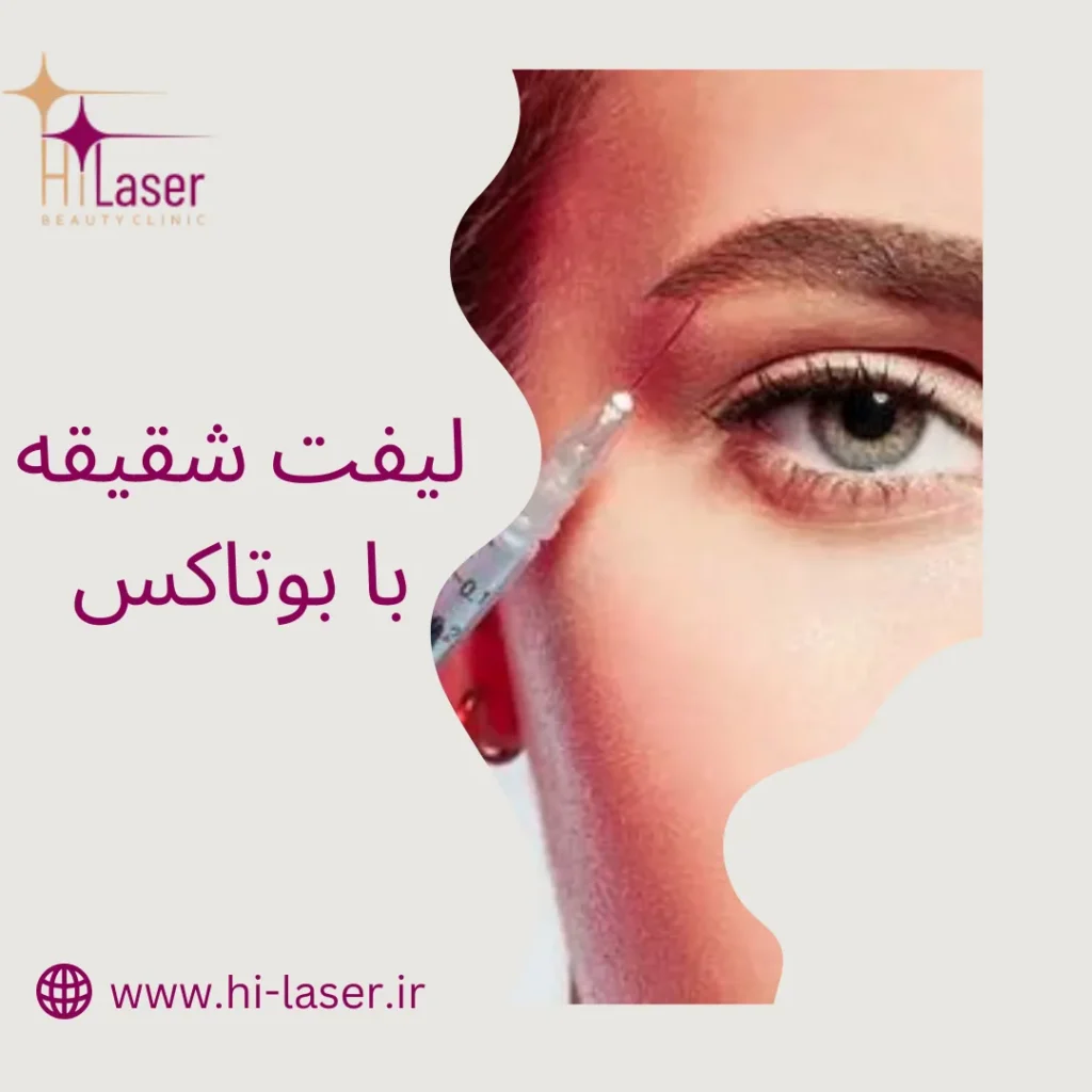 لیفت شقیقه با بوتاکس